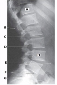 What anatomy is labeled with the letter B in the image below?   A)  Body of L2 B)  Body of L3 C)  Pedicle of L2 D)  Pedicle of L3
