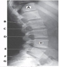 What anatomy is labeled with the letter D in the image below?   A)  Intervertebral foramen of L4-L5 B)  Zygapophyseal joint of L4-L5 C)  Intervertebral foramen of L3-L4 D)  Zygapophyseal joint of L3-L4