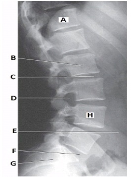 What anatomy is labeled with the letter C in the image below?   A)  Intervertebral foramen of L2-L3 B)  Intervertebral disk space of L2-L3 C)  Intervertebral foramen of L3-L4 D)  Intervertebral disk space of L3-L4