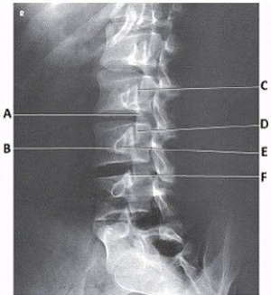 What anatomy is labeled with the letter E in the image below?   A)  L2 pedicle B)  L2 lamina C)  L3 pedicle D)  L3 lamina