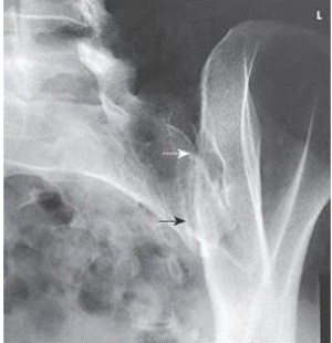 What anatomy is demonstrated in this AP oblique projection in the image below?   A)  Right SI joint B)  Left SI joint C)  L5-S1 joint space D)  L5-S1 zygapophyseal joint