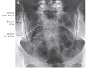 What anatomy and projection is demonstrated in the image below?   A)  AP axial sacrum B)  AP oblique SI joints C)  AP coccyx D)  AP axial lumbosacral junction (Ferguson method) 