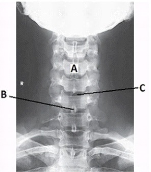 How is the central ray directed to obtain this image?   A)  15 to 20 degrees cephalad B)  15 to 20 degrees caudad C)  25 to 30 degrees cephalad D)  25 to 30 degrees caudad
