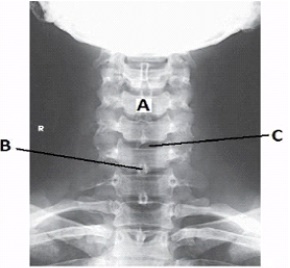 Letter A in the image below labels the _____ body.   A)  C2 B)  C3 C)  C4 D)  C5