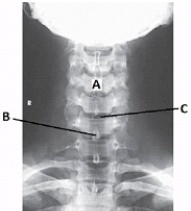 Letter B in the image below labels the:   A)  pedicle. B)  lamina. C)  spinous process. D)  transverse process.
