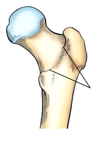 The area identified on the bone shown in this figure is the:   A)  posterior inferior spine. B)  lesser trochanter. C)  greater trochanter. D)  intertrochanteric crest.