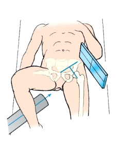 Which projection of the hip is shown in this figure?   A)  Lateral B)  Axiolateral C)  Axiolateral oblique D)  Superoinferior