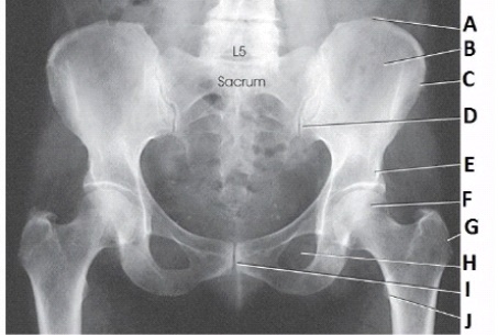 What anatomy is labeled as letter C in the image below?   A)  Iliac crest B)  Ala of ilium C)  ASIS D)  AIIS
