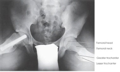 What projection and anatomy of interest is depicted in the image below?   A)  AP oblique (modified Cleaves) ,femoral necks B)  AP oblique (Cleaves) ,femoral necks C)  AP axial (Taylor) ,anterior pelvic bones D)  AP axial (Bridgeman) ,pelvic inlet