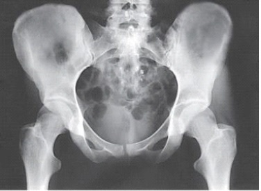 What positioning error is evident in the image below?   A)  None.This image meets all evaluation criteria for this projection. B)  The lower limbs were not internally rotated. C)  The lower limbs were not externally rotated. D)  The knees were not flexed to reduce lordotic curve.