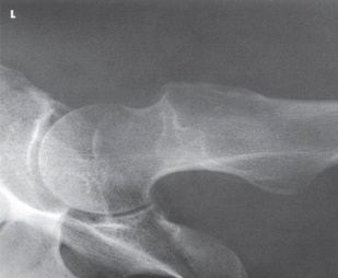 What projection (method) is demonstrated in the image below?   A)  AP oblique (modified Cleaves)  B)  Mediolateral (Lauenstein)  C)  Axiolateral (Danelius-Miller)  D)  AP oblique (Judet) 