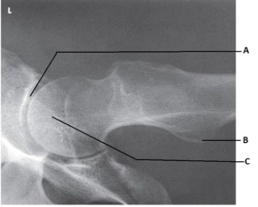 What anatomy is labeled as letter A in the image below?   A)  Acetabulum B)  Femoral head C)  Femoral neck D)  Greater trochanter