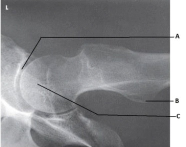 What anatomy is labeled as letter B in the image below?   A)  Acetabulum B)  Femoral head C)  Lesser trochanter D)  Iliac crest