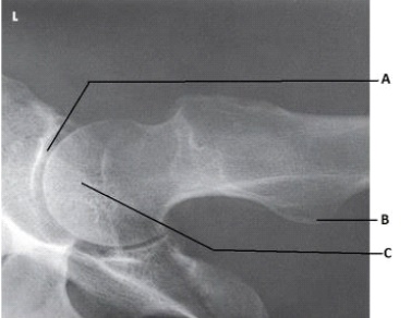 What anatomy is labeled as letter C in the image below?   A)  Acetabulum B)  Femoral head C)  Femoral neck D)  Iliac crest