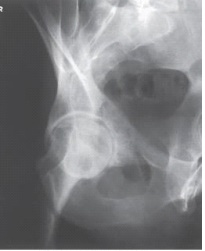 <strong>Examine this AP oblique (Judet)image of the right hip obtained with the patient positioned for the internal oblique.What patient position is depicted? </strong> A) 45 degrees RPO B) 45 degrees LPO C) 45 degrees RAO D) 45 degrees LAO