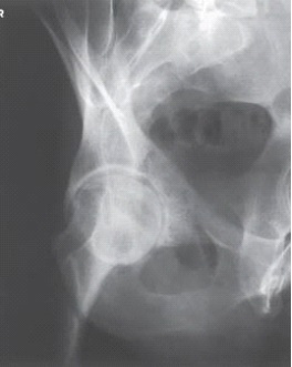 <strong>Examine this AP oblique (Judet)image of the right hip obtained with the patient positioned for the internal oblique.What is the anatomy of interest? </strong> A) Anterior acetabular rim and iliopubic column B) Posterior acetabular rim and iliopubic column C) Anterior acetabular rim and ilioischial column D) Posterior acetabular rim and ilioischial column