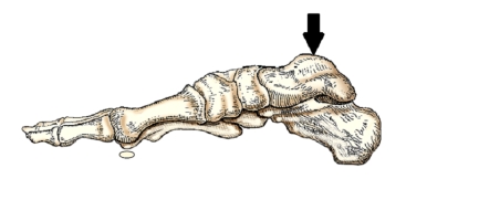 The bone of the foot indicated by the arrow in this figure is the:   A)  navicular. B)  talus. C)  calcaneus. D)  medial cuneiform.