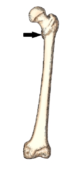 The bone part identified in this figure is the:   A)  lateral condyle. B)  medial condyle. C)  greater trochanter. D)  lesser trochanter.