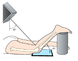 The patient position and central-ray method demonstrated in this figure is the:   A)  Holmblad (intercondylar fossa) . B)  Camp-Coventry (intercondylar fossa) . C)  Settegast (patellofemoral joint) . D)  Hughston (patellofemoral joint) .