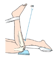 The projection of the patella demonstrated in this figure is the:   A)  Hughston. B)  Merchant. C)  Settegast. D)  Holmblad.