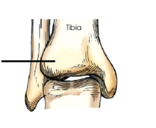 The area identified on the ankle illustration above is the:   A)  medial malleolus. B)  lateral malleolus. C)  anterior tubercle. D)  lateral tubercle.