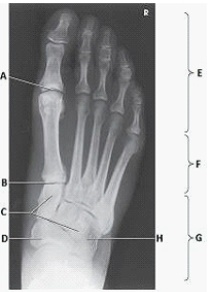 What anatomy is labeled as letter A in the image below?   A)  First metatarsophalangeal joint B)  Proximal interphalangeal joint of first digit C)  Distal interphalangeal joint of first digit D)  Interphalangeal joint of first digit