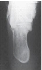 What is the projection and anatomy of interest depicted in the image below?   A)  AP axial calcaneus B)  AP calcaneus C)  Plantodorsal axial calcaneus D)  Superoinferior axial calcaneus