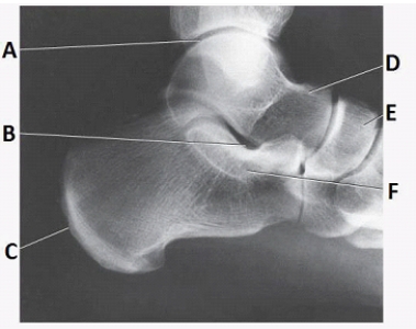 What anatomy is labeled as letter A in the image below?   A)  Tibiotalar joint B)  Tibiofibular joint C)  Sinus tarsi D)  Tibiocalcaneal joint