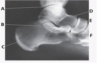 What anatomy is labeled as letter D in the image below?   A)  Tibia B)  Fibula C)  Talus D)  Calcaneus