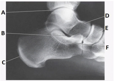 What anatomy is labeled as letter E in the image below?   A)  Sinus tarsi B)  Sustentaculum tali C)  Navicular D)  Tibiotalar joint