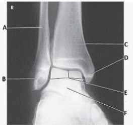 What anatomy is labeled as letter E in the image below?   A)  Sinus tarsi B)  Tibiotalar joint C)  Mortise joint D)  Medial malleolus