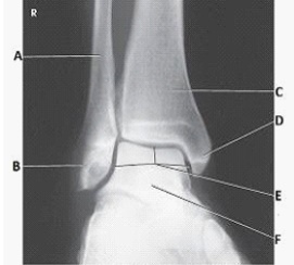 How is the lower limb positioned to obtain the projection in the image below?   A)  30- to 45-degree medial rotation B)  15- to 20-degree medial rotation C)  30- to 45-degree lateral rotation D)  15- to 20-degree lateral rotation