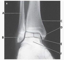 What anatomy is labeled with the letter D in the image below?   A)  Lateral malleolus B)  Medial malleolus C)  Talus D)  Tibiotalar joint