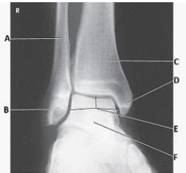 What anatomy is labeled with the letter B in the image below?   A)  Lateral malleolus B)  Medial malleolus C)  Talus D)  Tibiotalar joint