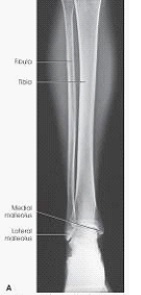 What is needed to complete the projection of the leg in the image below?   A)  Nothing.This is a complete projection B)  An AP of the knee and proximal leg C)  An AP of the ankle and distal leg D)  A lateral projection of the knee