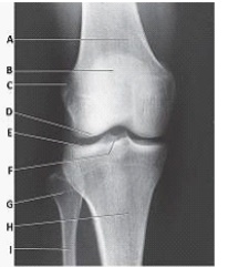 The anatomy labeled with letter E in the image below is the:   A)  medial femoral condyle. B)  lateral tibial condyle. C)  medial tibial condyle. D)  lateral tibial plateau.