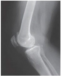 What is the central-ray direction needed to produce the image below?   A)  Perpendicular B)  3 to 5 degrees cephalad C)  5 to 7 degrees cephalad D)  Central-ray angle depends upon patient size
