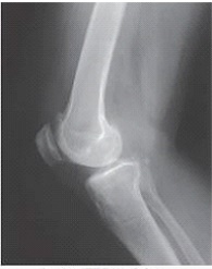 Where does the central ray enter the patient in the image below?   A)  Inch below the patellar apex B)  1 inch below the patellar apex C)  Inch proximal to the medial epicondyle D)  1 inch distal to the medial epicondyle