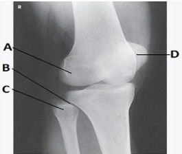 What lower limb position is required to obtain the image below?   A)  Anatomic position B)  45-degree medial rotation C)  45-degree lateral rotation D)  Tibial epicondyles perpendicular to IR