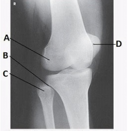 What anatomy is labeled with the letter B in the image below?   A)  Lateral femoral condyle B)  Lateral tibial condyle C)  Proximal tibiofibular joint D)  Tibial tuberosity