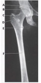 What anatomy is labeled with the letter C in the image below?   A)  Greater trochanter B)  Lesser trochanter C)  Femoral head D)  Femoral neck