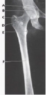 What is the projection and anatomy of interest in the image below?   A)  AP proximal femur B)  AP distal femur C)  Lateral proximal femur D)  Lateral distal femur