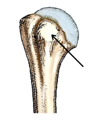 The small,rounded,elevated process identified by the arrow in this figure is the:   A)  acromion. B)  anatomic neck. C)  greater tubercle. D)  lesser tubercle.