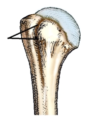 The depression identified in this figure is called the:   A)  infraspinous fossa. B)  supraspinous fossa. C)  intertubercular groove. D)  surgical neck.