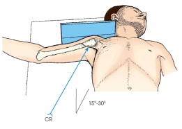 The projection of the shoulder demonstrated in this figure is the:   A)  axiolateral. B)  inferosuperior axial (Lawrence) . C)  transthoracic lateral (Lawrence) . D)  acromioclavicular (Pearson) .