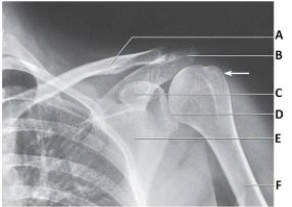 The projection in the image below was obtained with the arm positioned in:   A)  neutral position. B)  external rotation. C)  internal rotation. D)  oblique rotation.