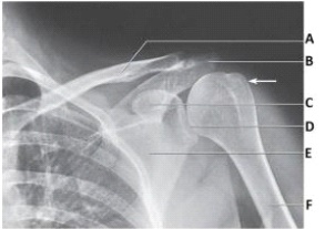 Letter A in the image below labels the:   A)  acromion. B)  coracoid process. C)  clavicle. D)  first rib.