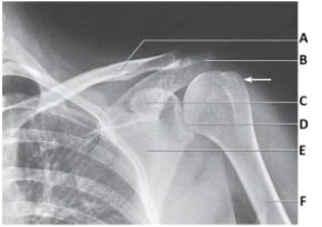 Letter B in the image below labels the:   A)  acromion. B)  coracoid process. C)  clavicle. D)  glenoid.