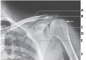Letter C in the image below labels the:   A)  acromion. B)  coracoid process. C)  clavicle. D)  glenoid.