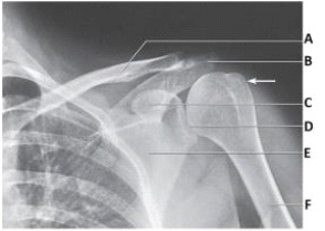 The white arrow in the image below points to the:   A)  acromion. B)  coracoid process. C)  greater tubercle. D)  lesser tubercle.